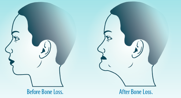 Bone Loss | Perfect Pearls