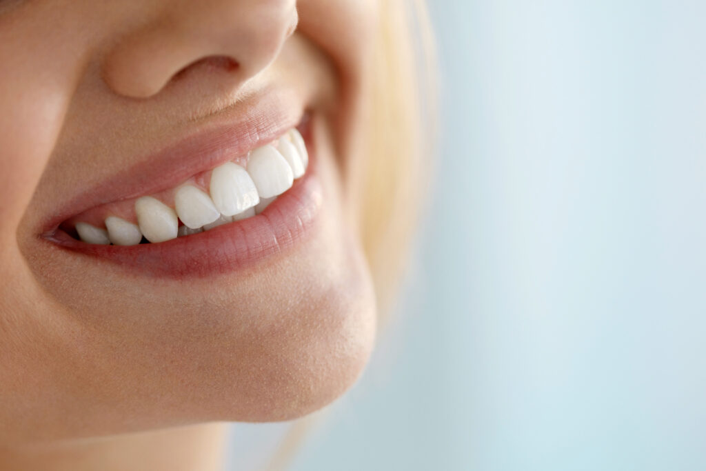 Close up of woman's white, bright smile after teeth whitening with advanced teeth whitening